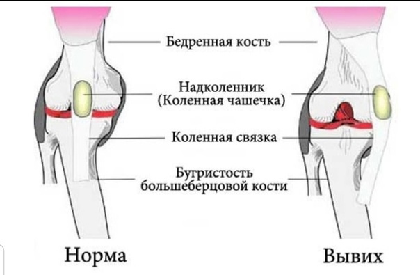 Чем опасен вывих шейных позвонков?