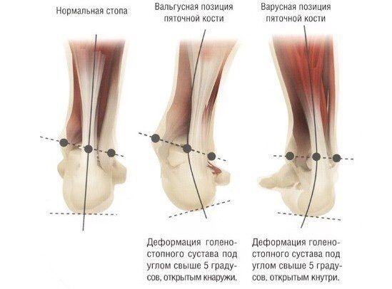 Что будет если не лечить Вальгусную стопу?