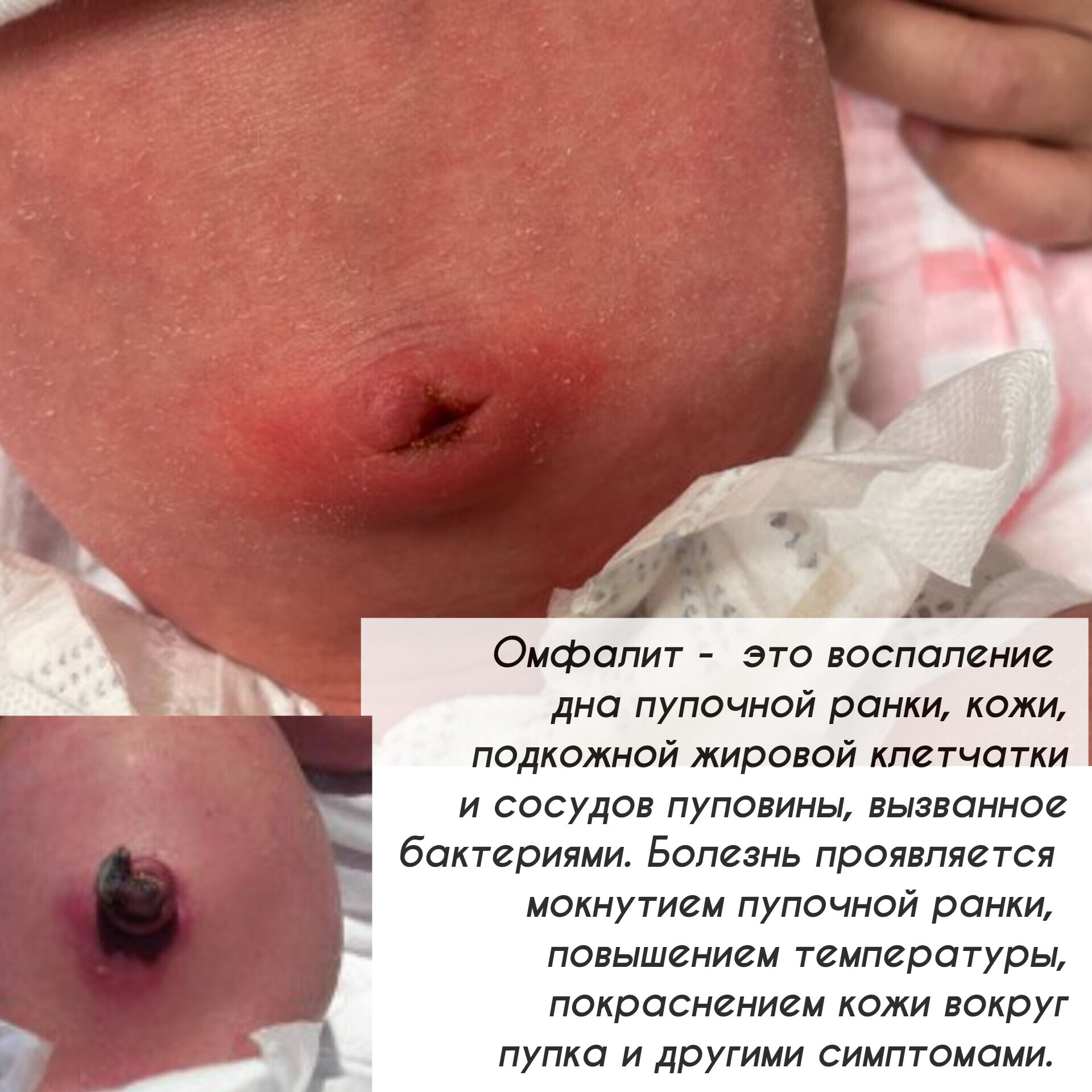 Что делать когда отпала прищепка с пупка?