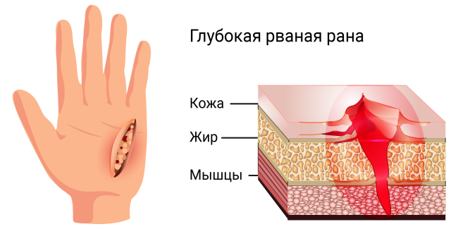 Что делать при открытой ране пальца?