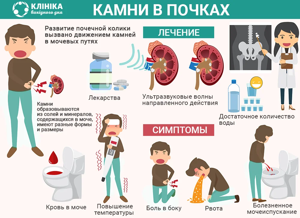 Что делать при почечной колики в домашних условиях?