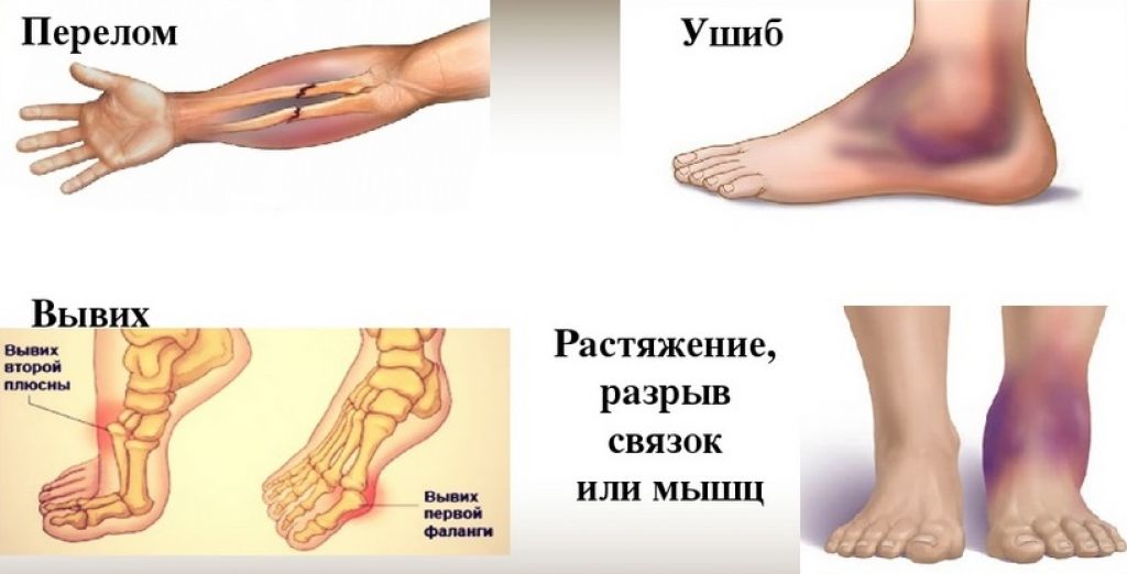 Что делать при сильном ушибе кисти руки?