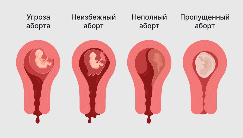 Что если во время беременности идет кровь?