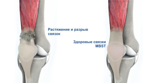 Что характерно для разрыва сухожилий?