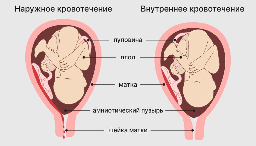 Что может вызвать кровотечение при беременности?