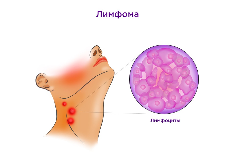 Что означает Ходжкина?