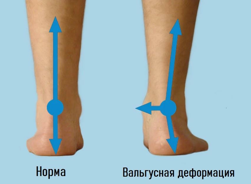 Что такое Вальгус стоп?