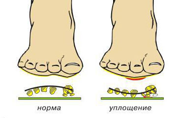 Что такое поперечное плоскостопие и как его лечить?