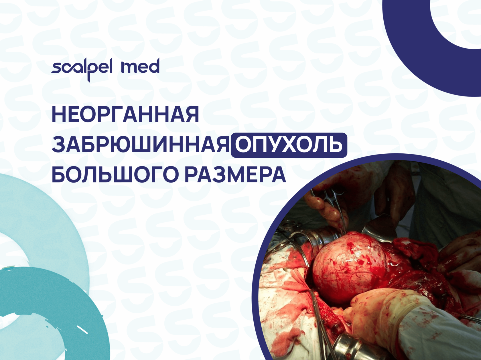 Что такое забрюшинная опухоль?