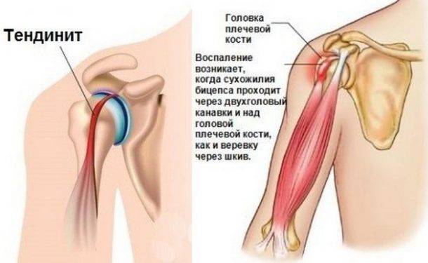 Что за болезнь тендинит?
