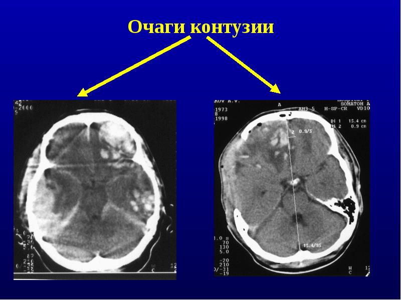 Что значит контуженный человек?