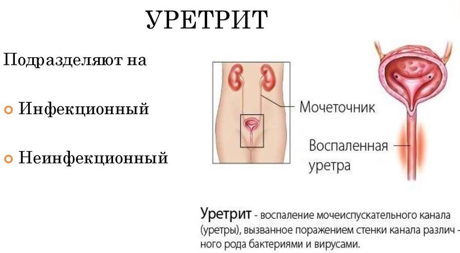 Как болят мочеточники у женщин?
