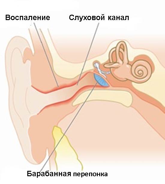 Как долго лечится наружный отит?