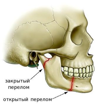Как долго срастается перелом челюсти?