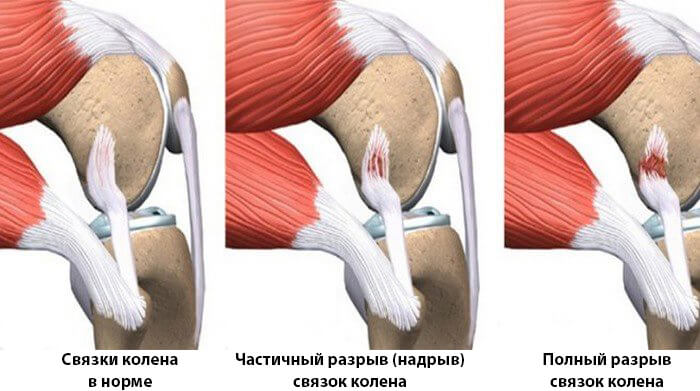 Как долго восстанавливаются связки коленного сустава?