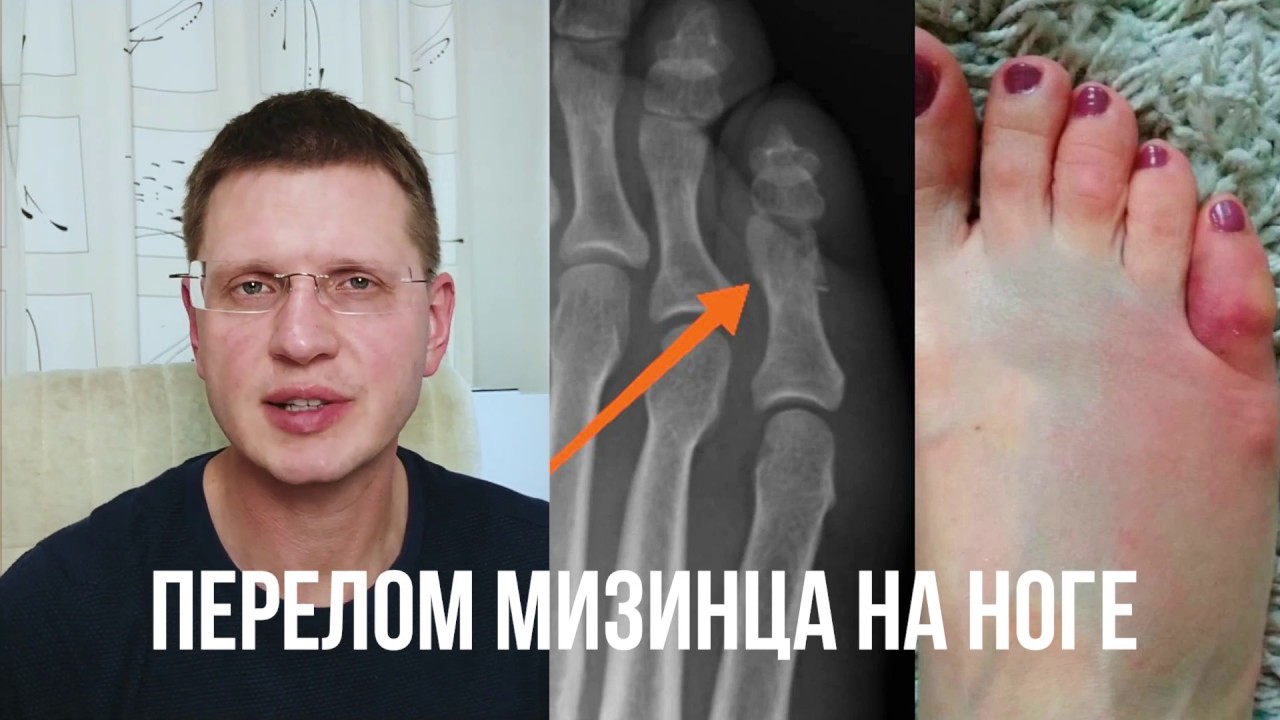 Как долго заживает перелом мизинца на ноге?