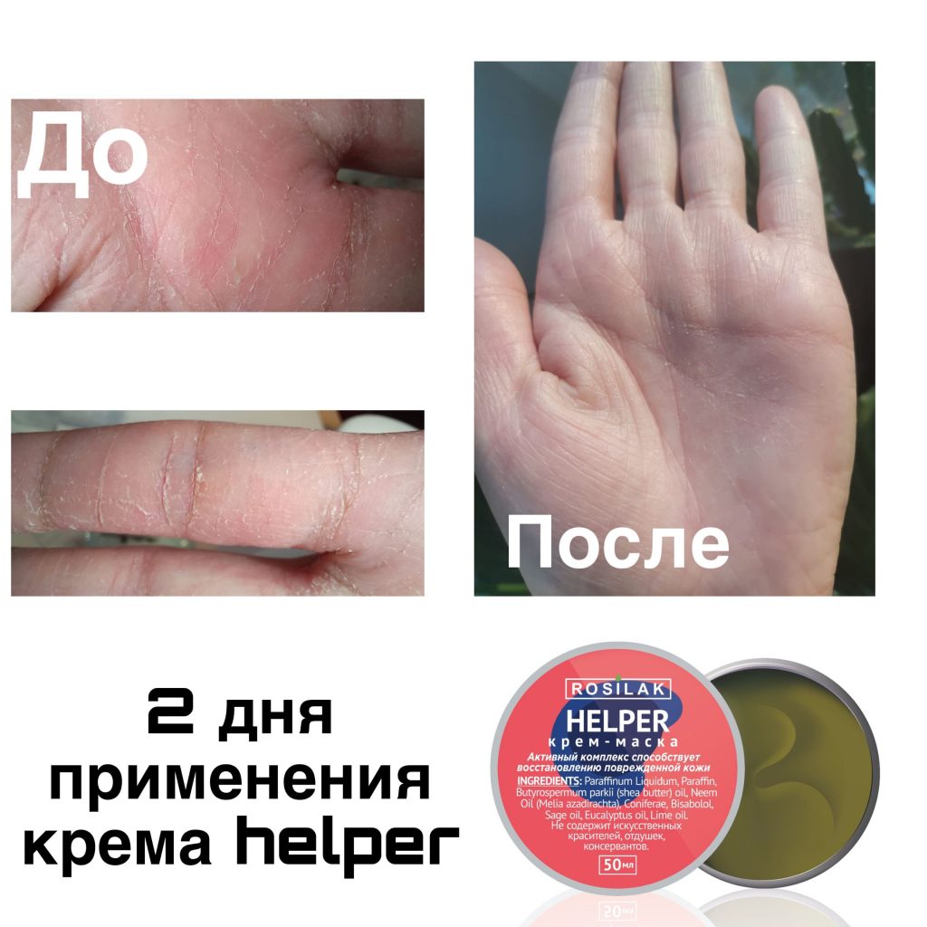 Как избавиться от аллергии мастеру маникюра?