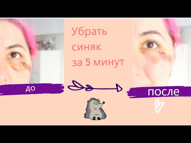 Как избавиться от гематомы под глазом?
