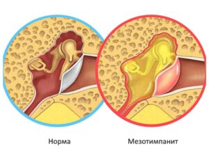 Как лечить Мезотимпанит?