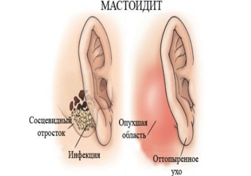 Как лечить хронический мастоидит?