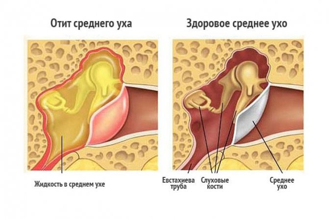 Как лечить отит у взрослых?