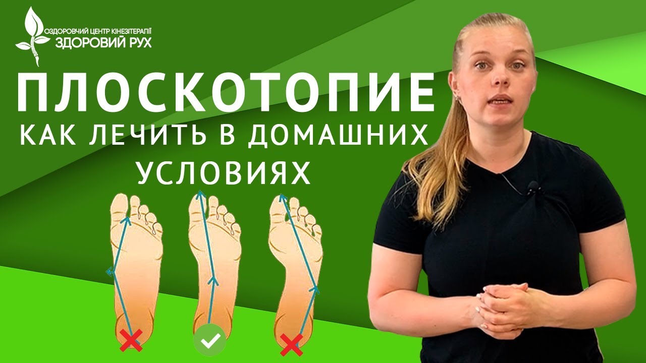 Как лечить плоскостопие у ребенка 10 лет?