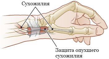 Как лечить тендовагинит?