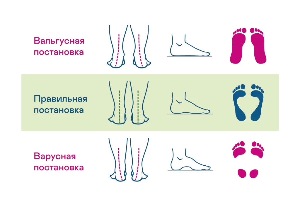 Как можно вылечить Вальгус?