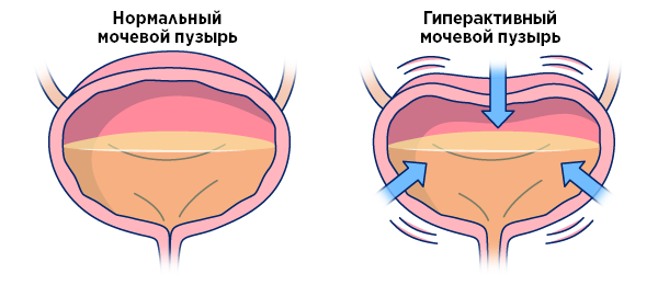 Как определить что болит мочевой пузырь?