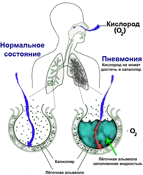 Как пить асд при пневмонии?