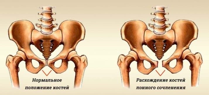 Как проявляется Симфизит?