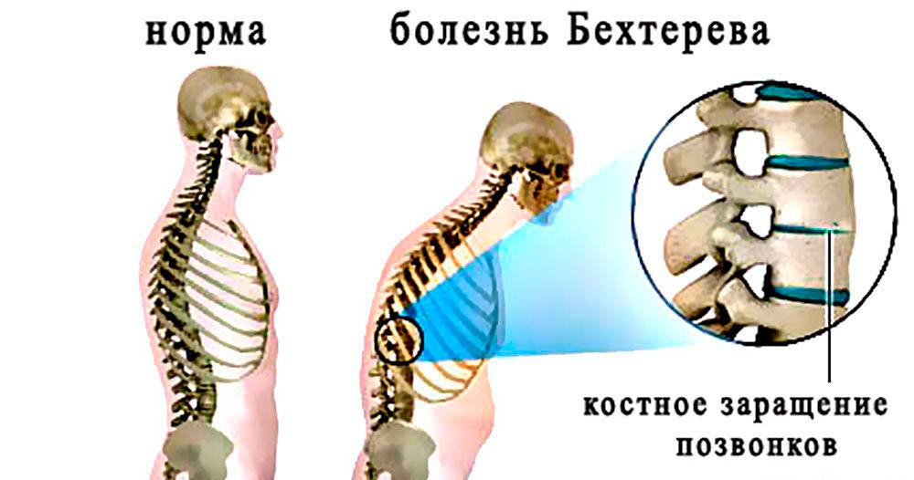 Как развивается болезнь Бехтерева?
