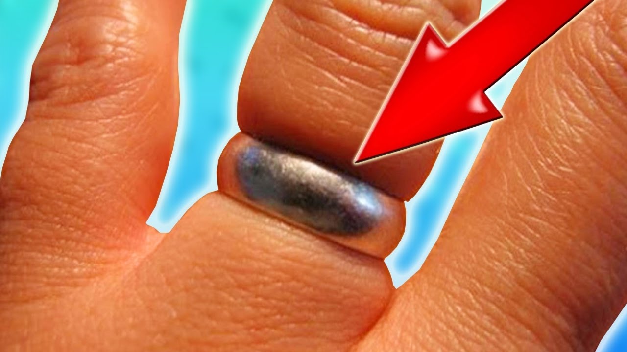 Как снять кольцо с пальца если палец сильно опух?