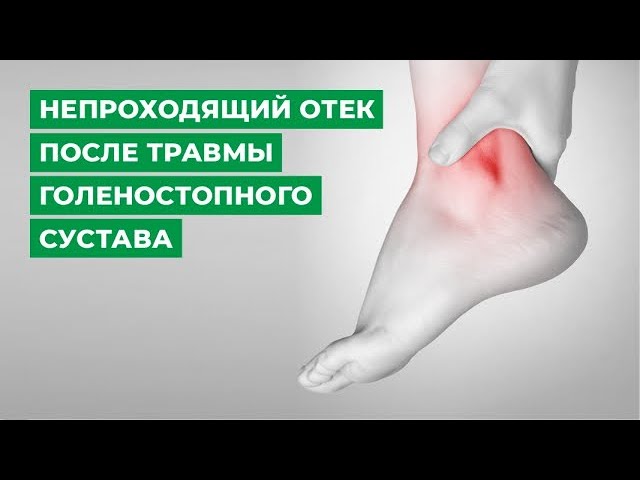 Как снять отек после снятия гипса?