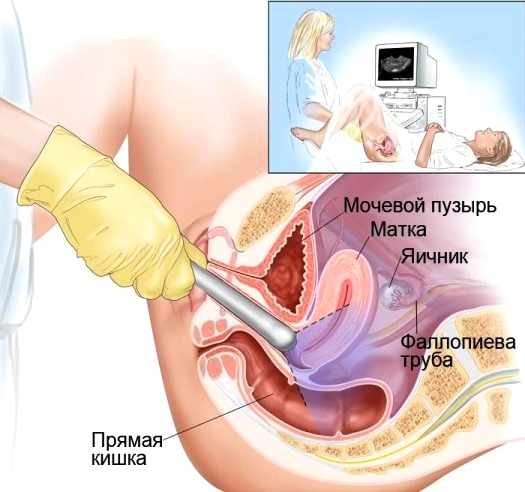 Как удаляют опухоль из матки?