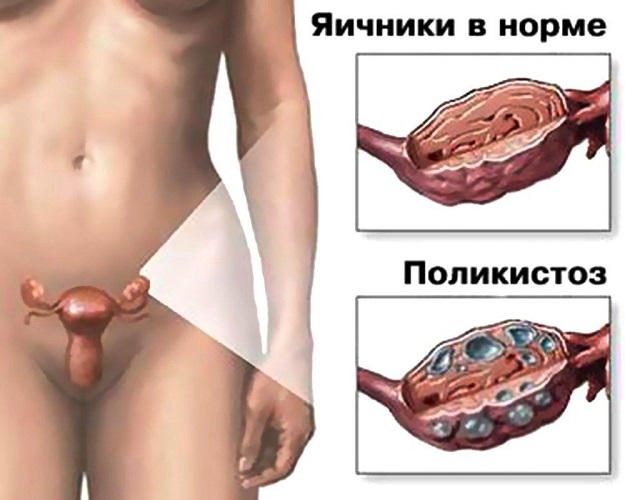 Как вылечить синдром поликистозных яичников?
