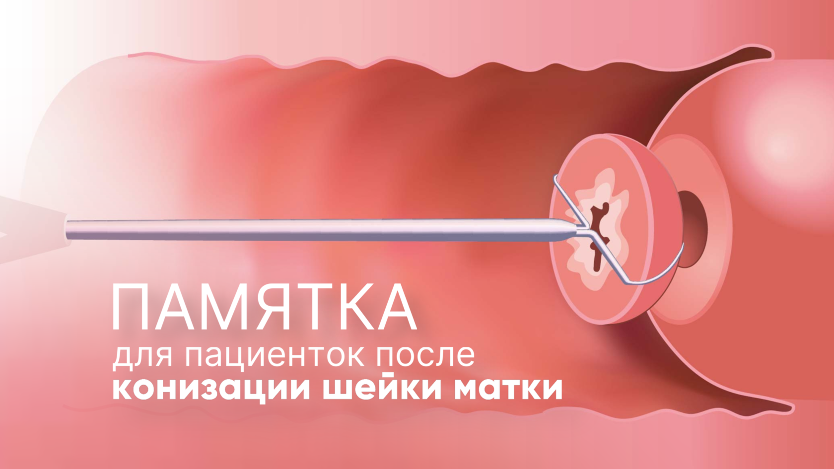 Какие последствия могут быть после конизации шейки матки?