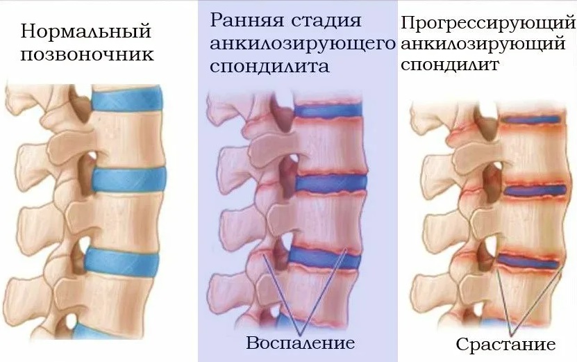 Какие признаки болезни Бехтерева?