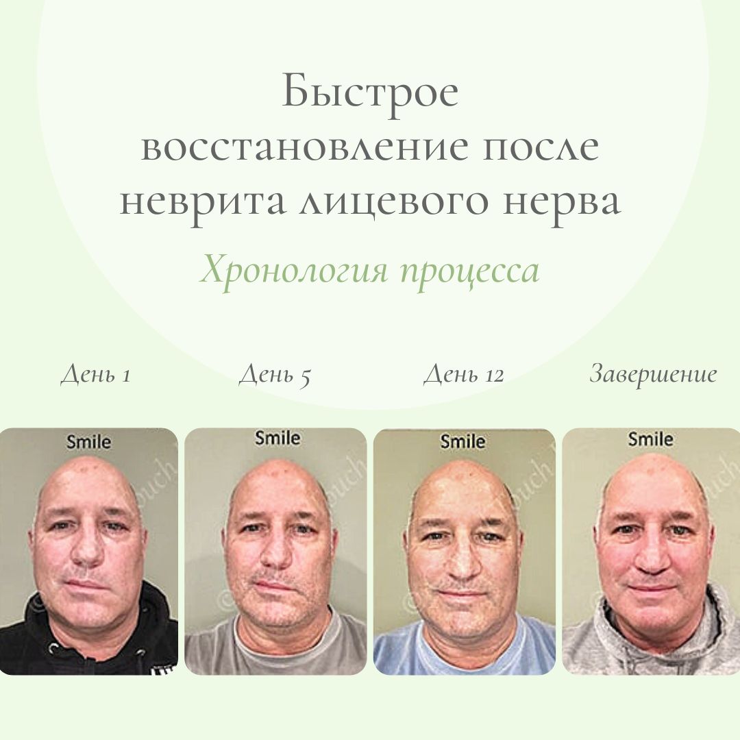Какие таблетки принимать при неврите лицевого нерва?
