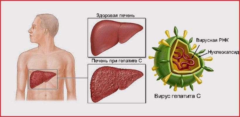 Какой самый опасный вид гепатита?