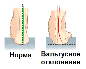 Когда Вальгус норма?