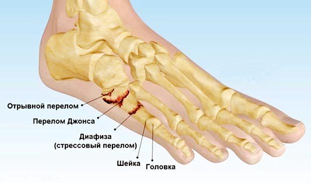 Можно ли наступать на ногу при переломе 5 плюсневой кости?