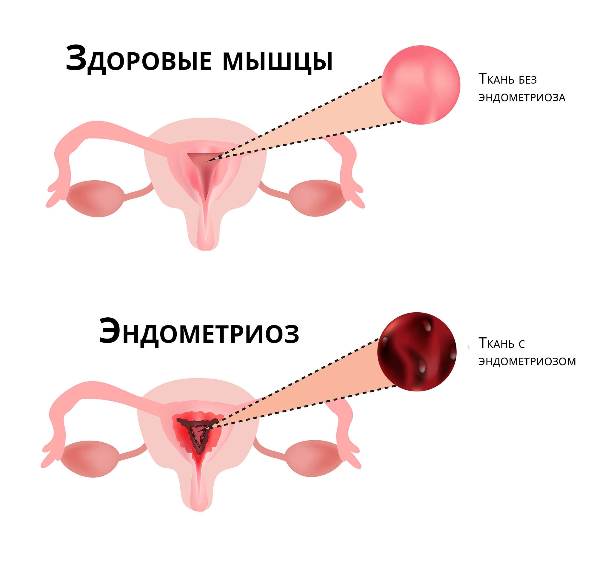 Можно ли по узи определить климакс?