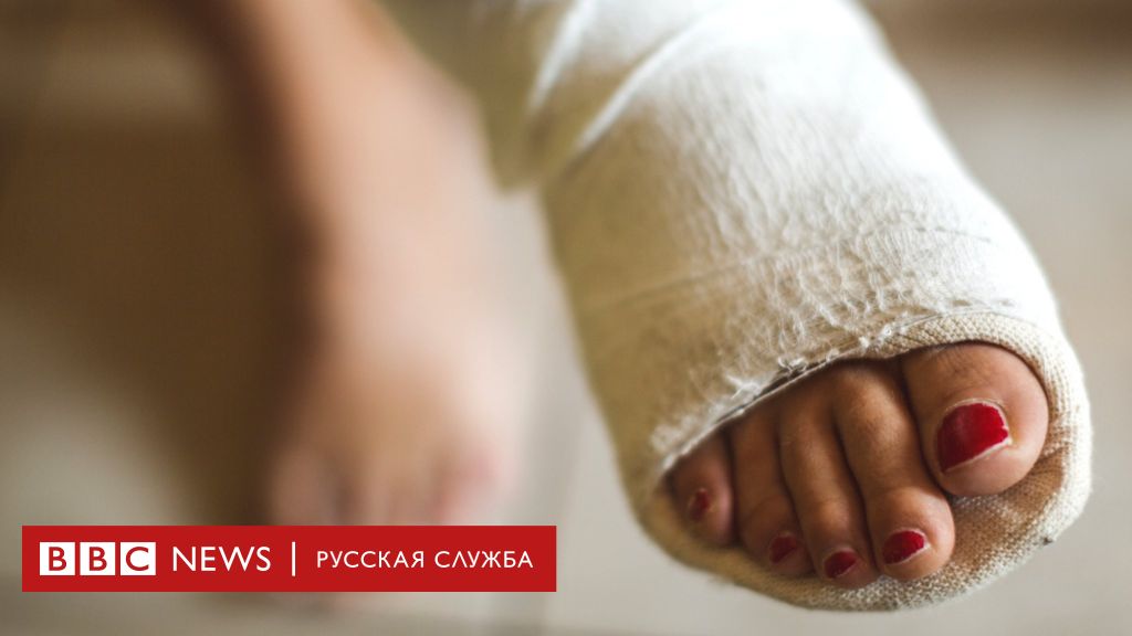Можно ли сломать палец на ноге и не заметить?