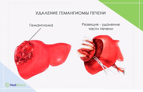 Можно ли умереть от гемангиомы печени?