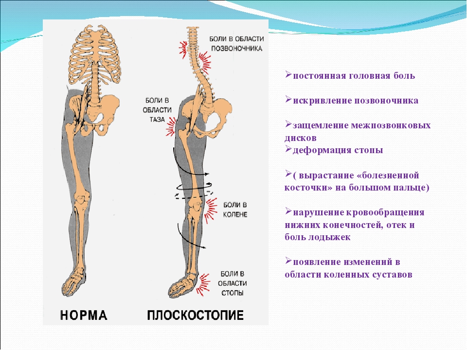 Можно ли вылечить плоскостопие стельками?