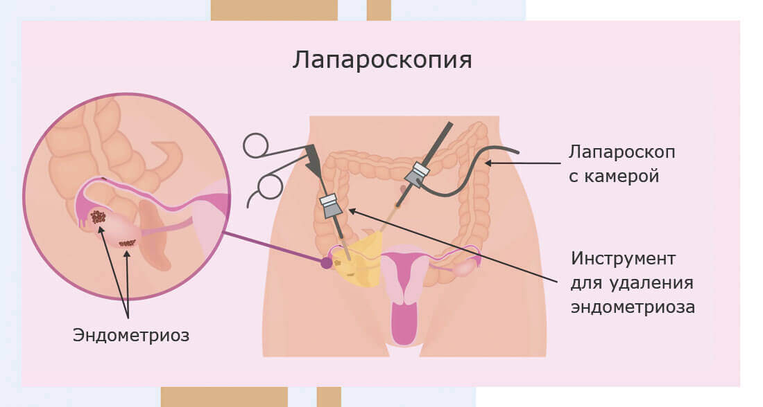 Можно ли забеременеть после лапароскопии кисты яичника?
