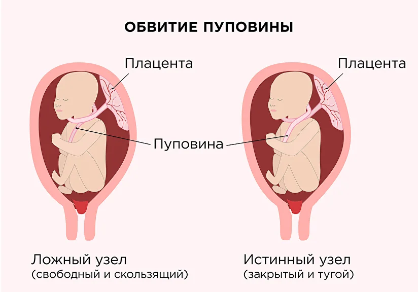 На каком сроке ребенок может обвитие пуповиной?