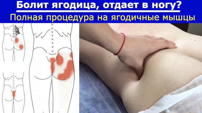 Почему больно сидеть на ягодицах?