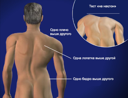 Почему одна лопатка выше другой?